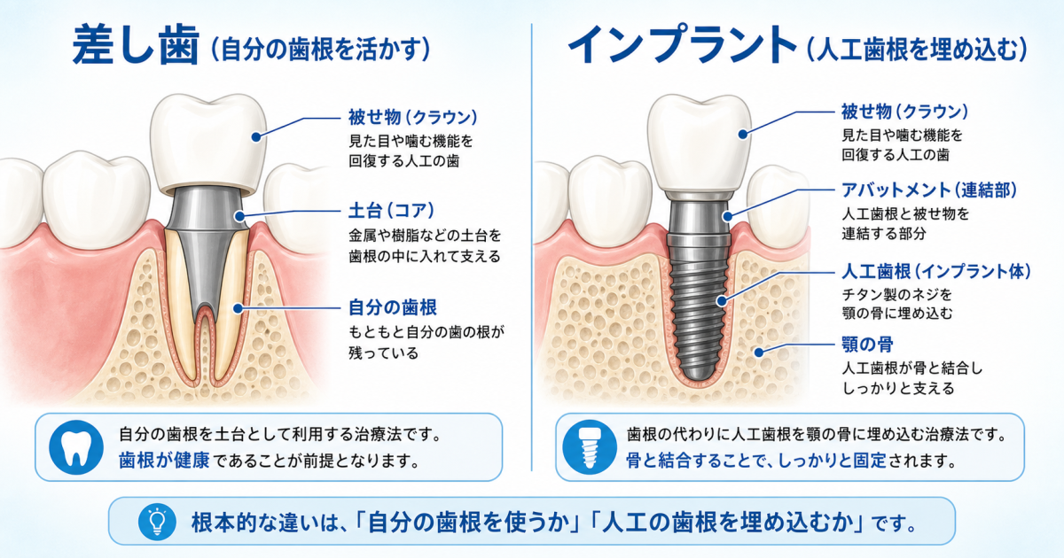 前歯の差し歯とインプラントの根本的な構造・仕組みの違い