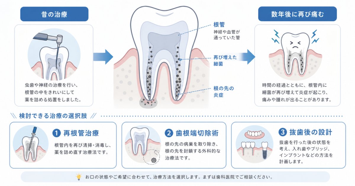 昔治療した歯がまた痛む原因は?再発理由と歯を残す3つの選択肢