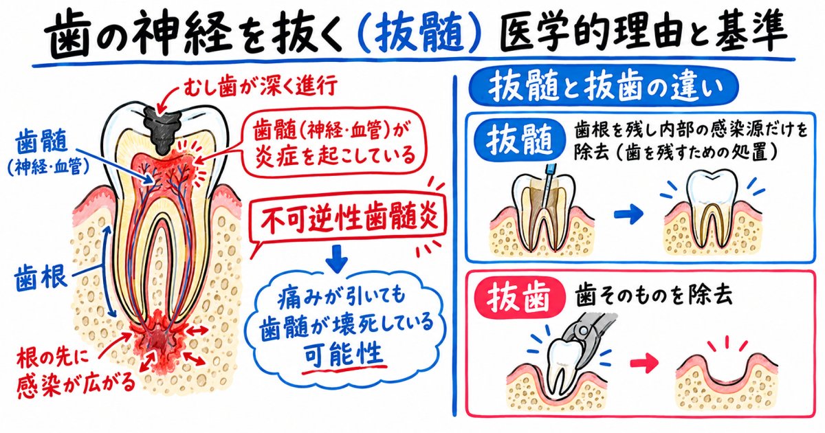 歯の神経を抜く医学的理由とは?抜髄と判断される具体的な基準