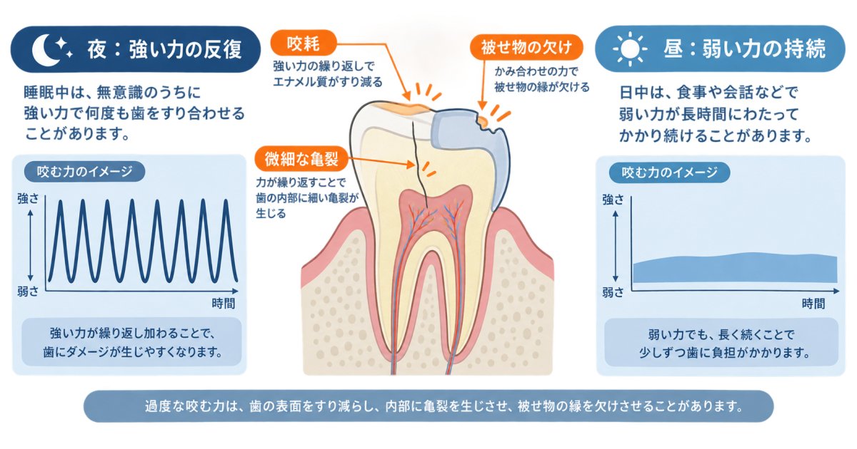 歯ぎしり・食いしばりが歯を壊す仕組み