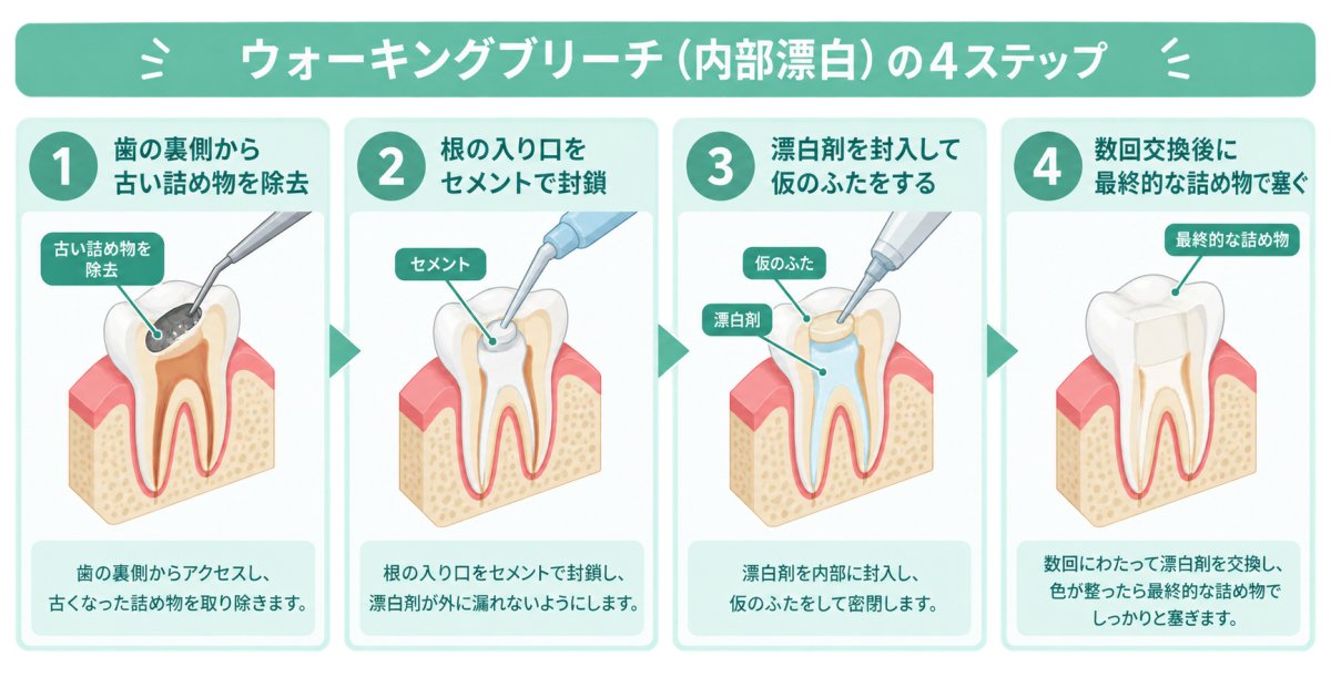 内部漂白(ウォーキングブリーチ)はどんな歯に使えるの?